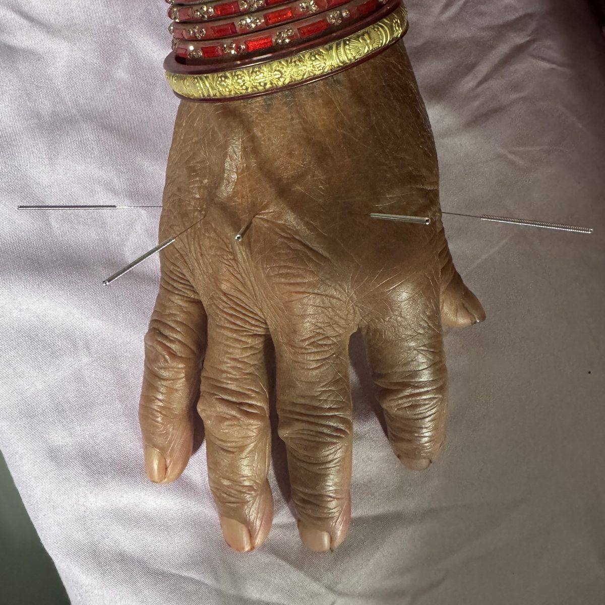 Des aiguilles d'acupuncture posées sur le dos d'une main, au Népal.