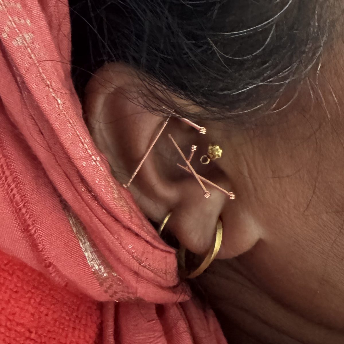 Des aiguilles d'acupuncture posées dans le pavillon d'une oreille, au Népal.