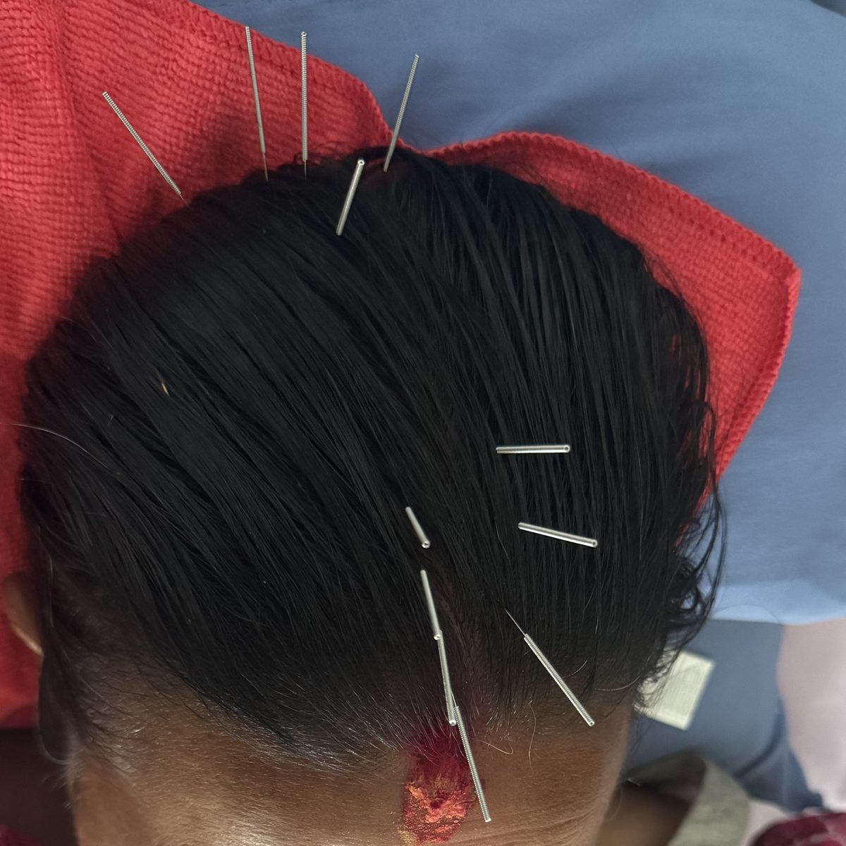 Des aiguilles d'acupuncture posées sur le cuir chevelu, au Népal.